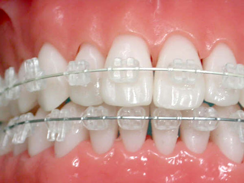 陶瓷托槽和金属口腔正畸专科 牙齿矫正   临床上,很多患者都会面临