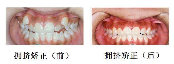 牙齿拥挤矫正多少钱?