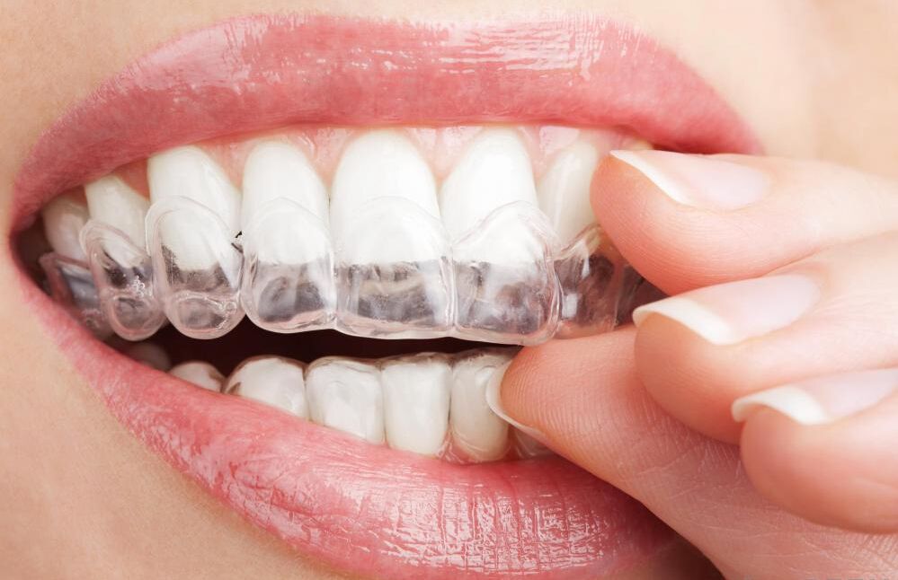 牙齿,容易出现蛀牙或者 牙周病等情况                    隐适美矫正