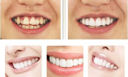成人牙齿矫正方法哪种比较好?