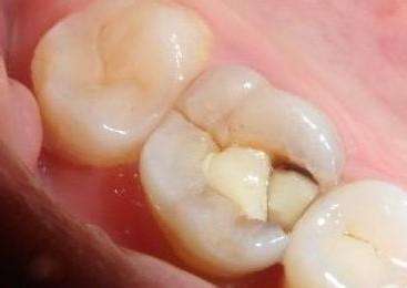 蛀牙初期没有洞,只能从外面看到一点点黑色,当蛀牙已经产生了牙洞