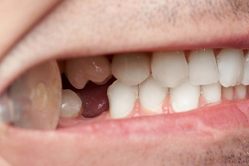 數字種牙與傳統植牙區別