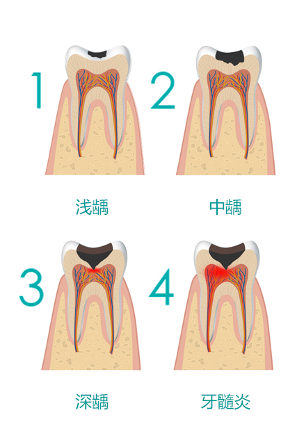 全数码微创瓷修复_牙齿龋坏怎么办_深圳爱康健口腔医院