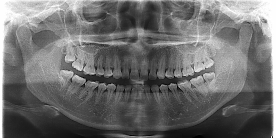 正常人牙齿侧面x光图片