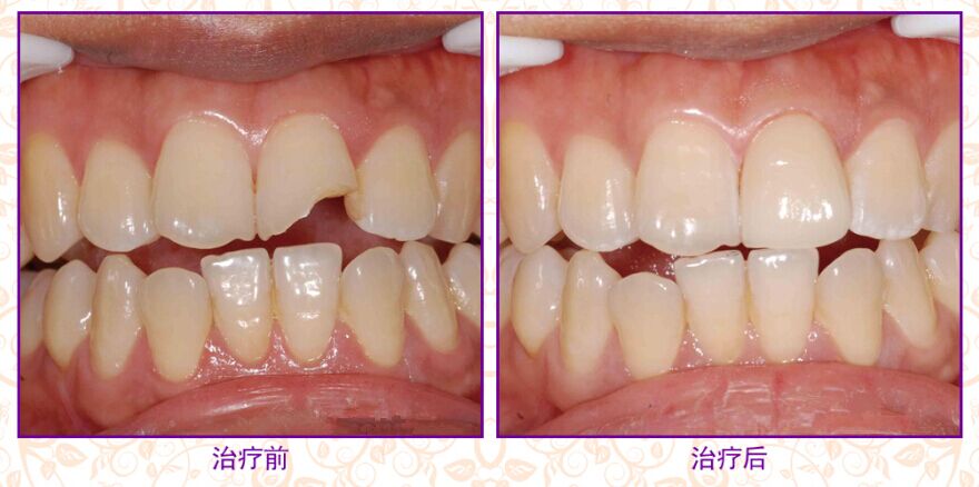 牙齿缺损修复对比图