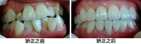 牙齿矫正